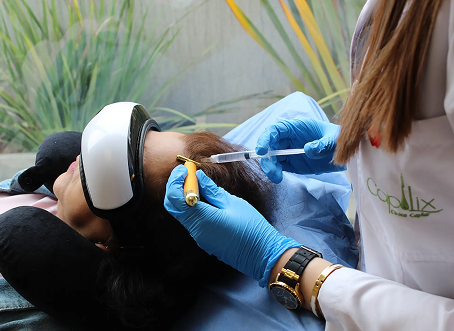 Una imagen de un procedimiento de mesoterapia capilar en progreso. Un profesional de la salud, con guantes de nitrilo azul y bata de laboratorio blanca, inyecta cuidadosamente una jeringa con una solución en el cuero cabelludo de un paciente cerca de la línea del cabello. El paciente está acostado de costado, usando gafas de blancas y negras y un reposacabezas negro para comodidad y distracción, con los ojos cerrados. La profesional sostiene una jeringa en una mano y una pequeña herramienta de guía dorada en la otra para la aplicación. El entorno es una clínica médica limpia, con un fondo de plantas de interior altas y verdes visibles a través de una ventana. La bata del profesional tiene un logotipo verde sutil y lleva un reloj negro y dorado y una pulsera dorada.