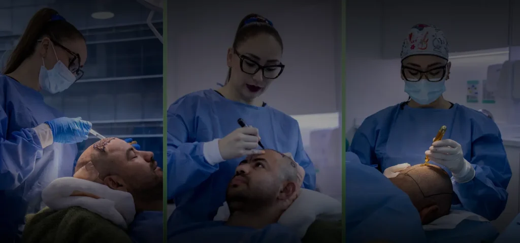 Tres paneles que muestran el proceso de microinjerto capilar: preparación de folículos, diseño de línea del cabello con marcador, y colocación de implantes en paciente masculino.