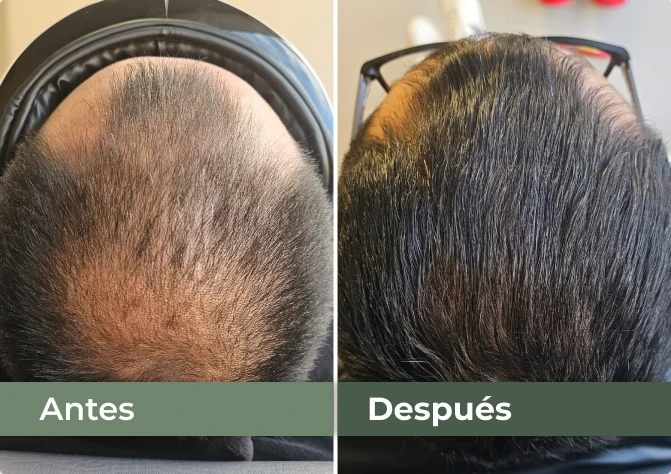 Una comparación fotográfica lado a lado de la coronilla de un paciente masculino antes y después de un injerto capilar FUE/DHI. El panel izquierdo está etiquetado como "Antes" y muestra calvicie avanzada con cabello muy escaso. El panel derecho está etiquetado como "Después" y muestra el mismo cuero cabelludo con una cobertura completa de cabello denso y de aspecto natural.